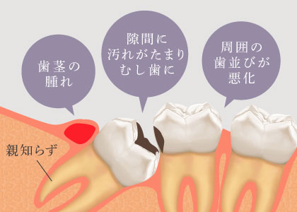 親知らず　歯茎の腫れ、隙間に汚れがたまりむし歯に、周囲の歯並びが悪化